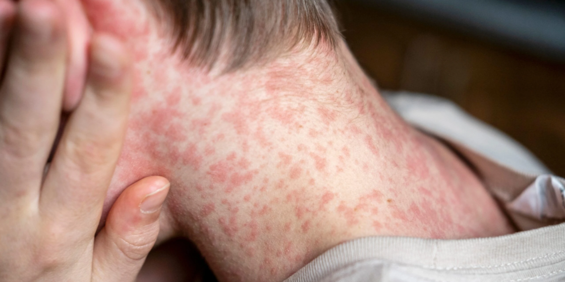 Минздрав сообщает: на рейсе в Израиль выявлены больные корью.