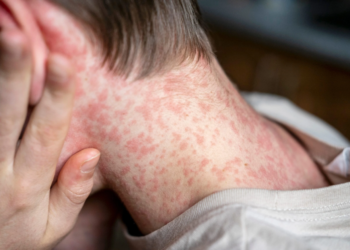 Минздрав сообщает: на рейсе в Израиль выявлены больные корью.